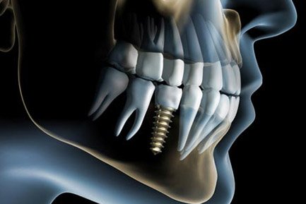 Dental Implant Clinic In Aundh Pune Dental Implant Clinic In Aundh Pune