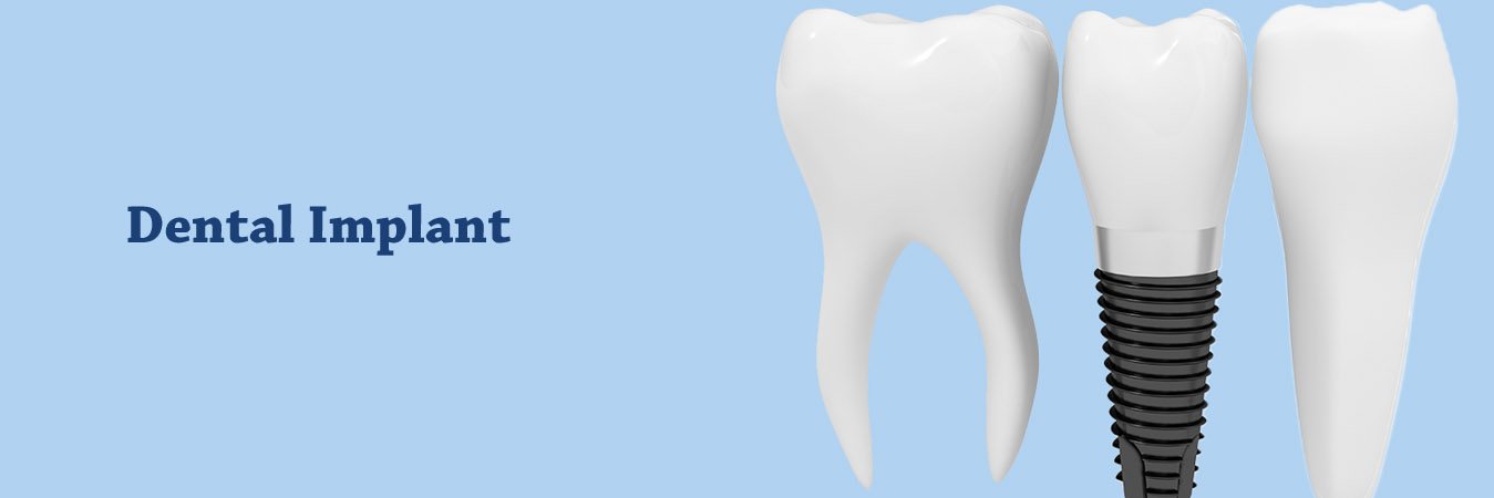 Dental Implant Clinic In Aundh Pune Dental Implant Clinic In Aundh Pune