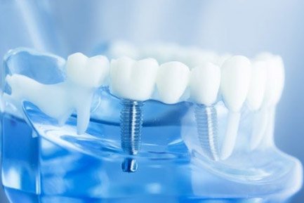 Dental Doctor In Aundh Pune Dental Doctor In Aundh Pune